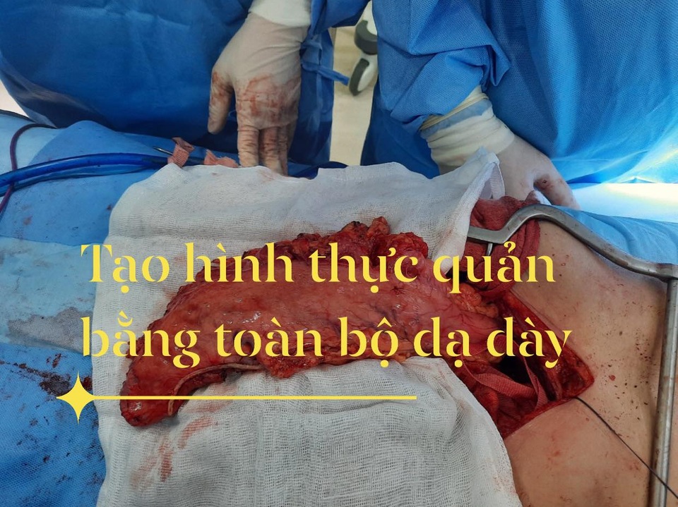 Ung thư thực quản có thể chữa khỏi nếu phát hiện sớm - 4 Ung thư thực quản có thể chữa khỏi nếu phát hiện sớm - 4