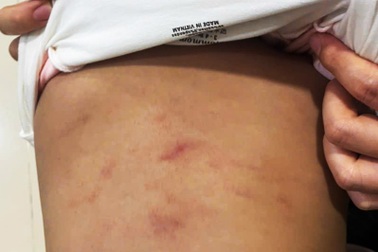 Bé gái 2 tuổi có dấu hiệu bị bạo hành ở nhóm trẻ tư thục