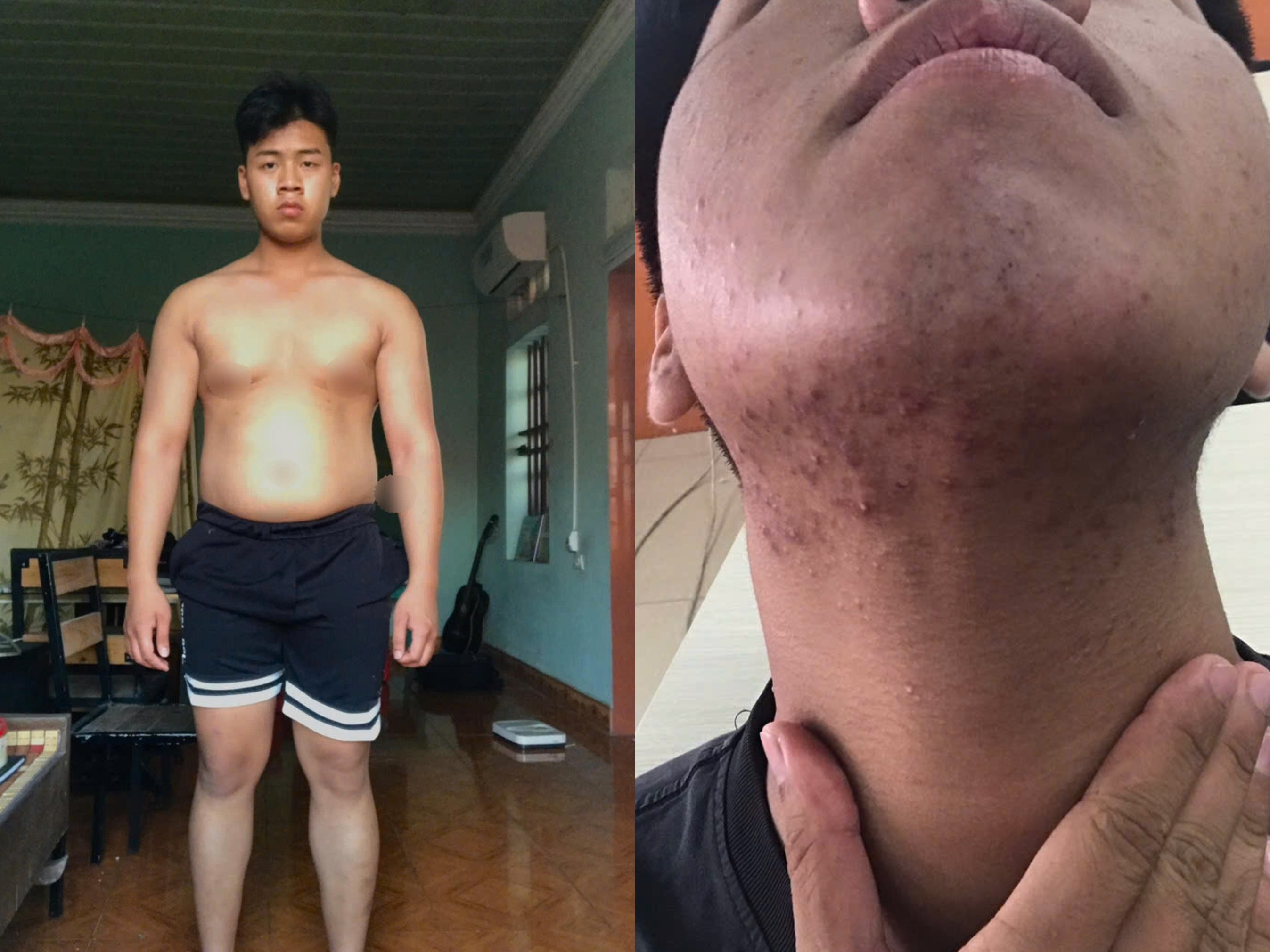 Thức khuya, coi nước tăng lực là thần dược, Gen Z 18 tuổi suy thận - 1