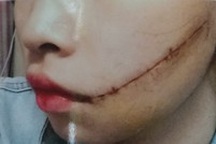 Trên đường đi làm, nữ công nhân bị rạch mặt khâu 25 mũi