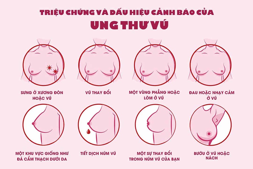 10 yếu tố làm tăng nguy cơ ung thư vú chị em cần lưu ý - 1 10 yếu tố làm tăng nguy cơ ung thư vú chị em cần lưu ý - 1
