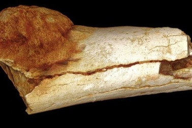 Phát hiện ung thư trong chân của tổ tiên người cổ đại