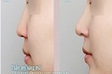 Những điều cần biết về nâng mũi Hàn Quốc S-Line: