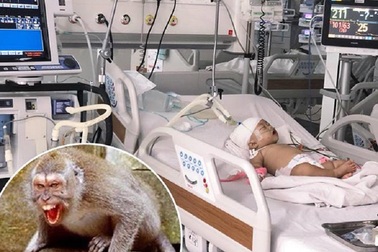 Bé 14 tháng tuổi bị khỉ cắn toạc da đầu, lún xương sọ