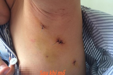 Mổ u xơ tuyến vú không để lại sẹo