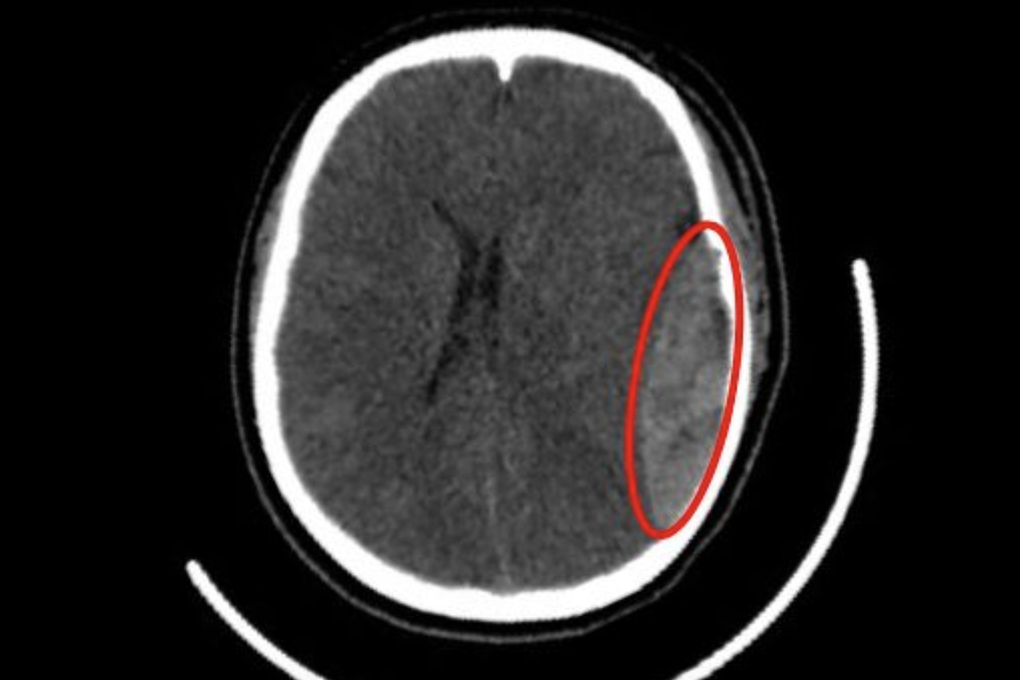 Tà áo dài cuốn vào bánh xe khi đi học, nữ sinh 15 tuổi phải mổ sọ não - 1 Tà áo dài cuốn vào bánh xe khi đi học, nữ sinh 15 tuổi phải mổ sọ não - 1