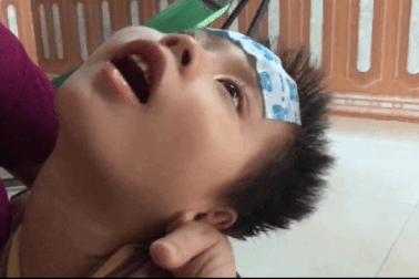 Bé gái 5 tuổi "mềm như sợi bún", người mẹ trẻ lo mất con bất cứ lúc nào