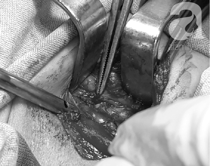 Bé trai 11 tháng tuổi thủng thực quản suýt chết bởi chính món đồ chơi quen thuộc bà mẹ nào cũng dùng để dỗ con - Ảnh 5.