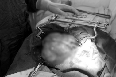 Thấy bụng to lên, người đàn ông phát hiện khối u ung thư tái phát lần 3