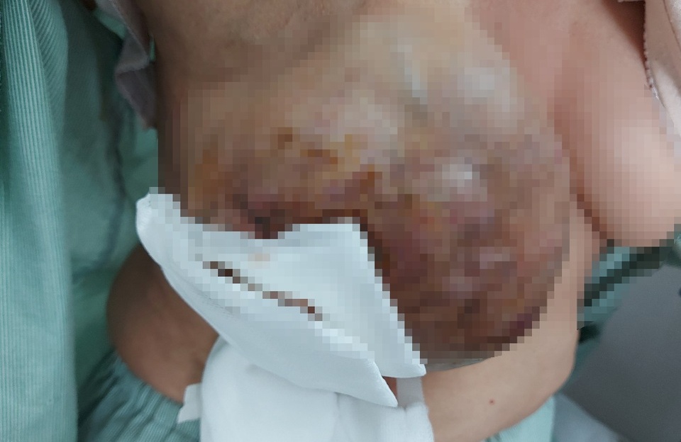 Hoảng hồn vú sùi loét, phun máu thành tia sau 20 năm tự điều trị ung thư - 1 Hoảng hồn vú sùi loét, phun máu thành tia sau 20 năm tự điều trị ung thư - 1