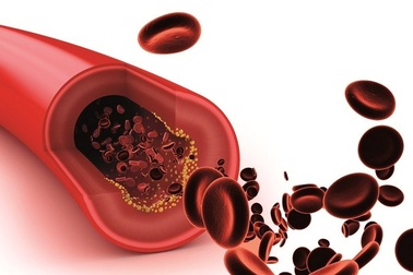 Thiếu máu cơ tim thầm lặng và những cách để giảm thiểu rủi ro