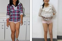 Cô gái “tự” kéo dài chân thêm 23cm