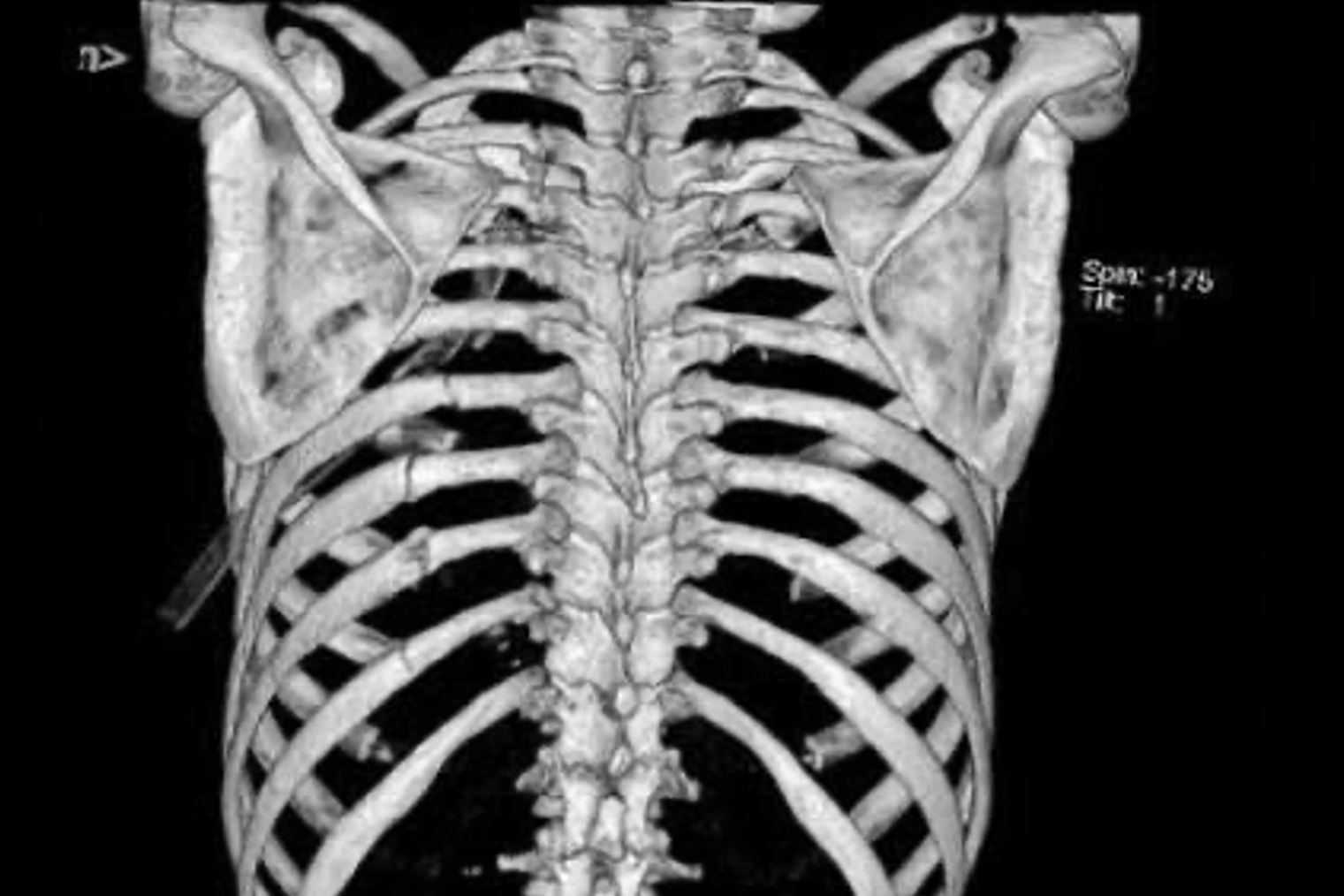 Trèo cây chôm chôm ngã từ độ cao 4 mét xuống đất, người phụ nữ nguy kịch - 1