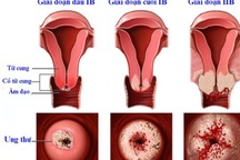 Các bước tầm soát ung thư cổ tử cung