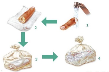 Cách xử trí người bị tai nạn đứt lìa một phần cơ thể