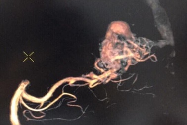 Nhập viện vì đột ngột đau đầu dữ dội, bác sĩ chỉ định nút mạch máu não