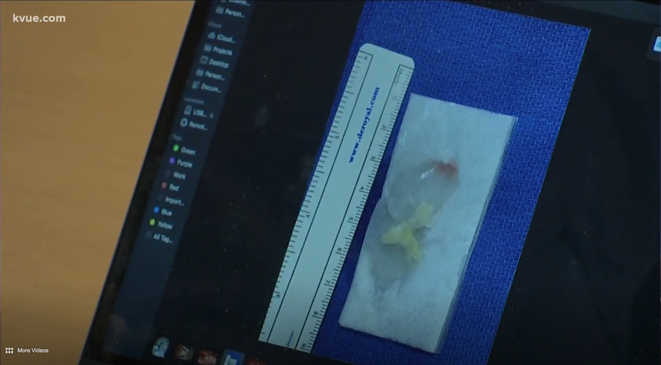 Ngất xỉu, đau đầu dữ dội vì sán sống trong não cả thập kỷ - 2 Ngất xỉu, đau đầu dữ dội vì sán sống trong não cả thập kỷ - 2