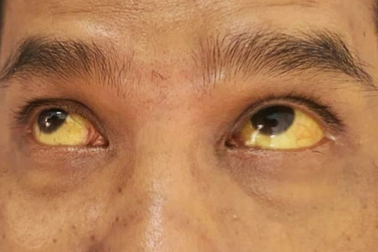 Căn bệnh có tỷ lệ nhiễm cao ở Việt Nam, nhiều người nhầm lẫn tai hại