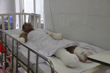 Liên tiếp 2 trường hợp phải đoạn tứ chi vì bỏng điện