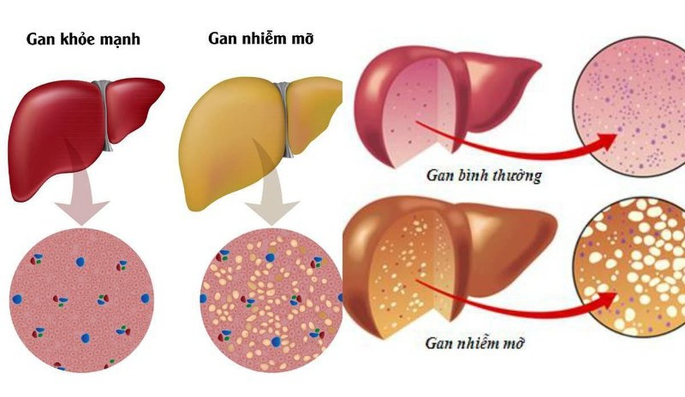 Hai biến chứng nguy hiểm của gan nhiễm mỡ - 1 Hai biến chứng nguy hiểm của gan nhiễm mỡ - 1