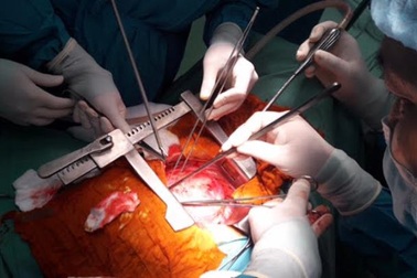 Khối u quái bẩm sinh nằm sát tim bệnh nhân suốt 41 năm