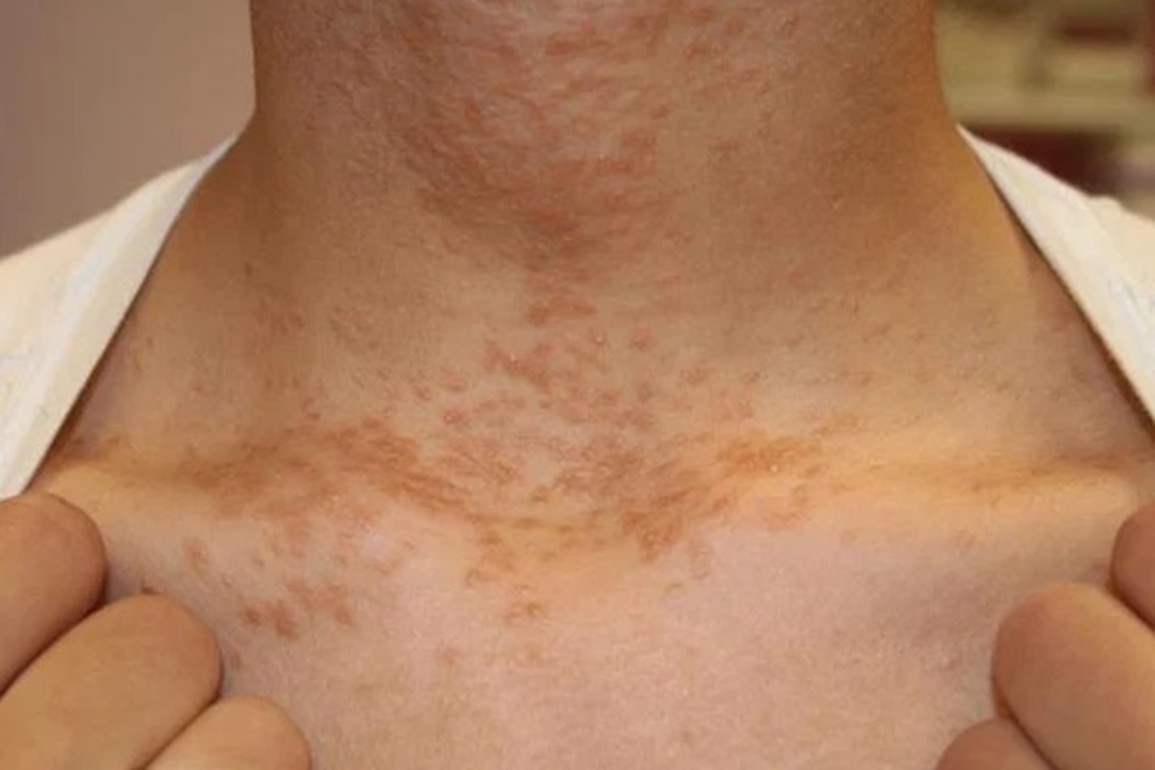 Những dấu hiệu bất thường ở cổ cảnh báo ung thư cận kề - 3 Những dấu hiệu bất thường ở cổ cảnh báo ung thư cận kề - 3