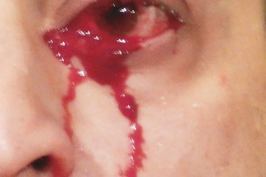 Kì lạ người đàn ông “khóc ra máu” liên tục trong… 1 giờ