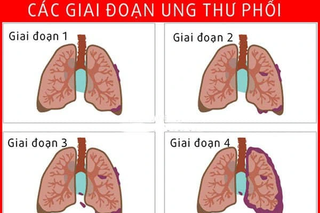 Khi nào bệnh nhân ung thư phổi cần thực hiện hóa trị, xạ trị? - 1 Khi nào bệnh nhân ung thư phổi cần thực hiện hóa trị, xạ trị? - 1