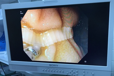 Vất vả lôi con sán dài cả thước trong người đàn ông quen ăn bò tái