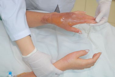 Hà Nội: Hóa chất thông bồn cầu phát nổ, người phụ nữ bỏng nặng