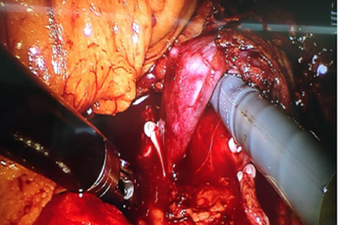 Lần đầu tiên dùng robot phẫu thuật lấy thận ghép