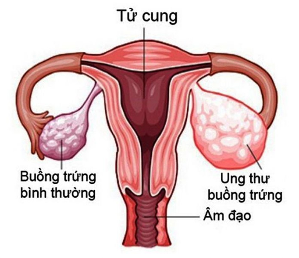 10 dấu hiệu khiến bạn nghĩ đến ung thư buồng trứng - 1 10 dấu hiệu khiến bạn nghĩ đến ung thư buồng trứng - 1