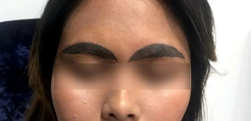 Cô gái khóc ròng vì có hai cặp lông mày sau khi phun xăm thẩm mỹ giá rẻ - 3 Cô gái khóc ròng vì có hai cặp lông mày sau khi phun xăm thẩm mỹ giá rẻ - 3