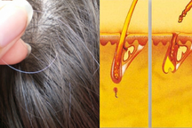 Bạc tóc sớm có phải do "máu xấu", mắc bệnh?