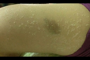 Lột da, tẩy trắng cấp tốc gây nguy cơ ung thư da