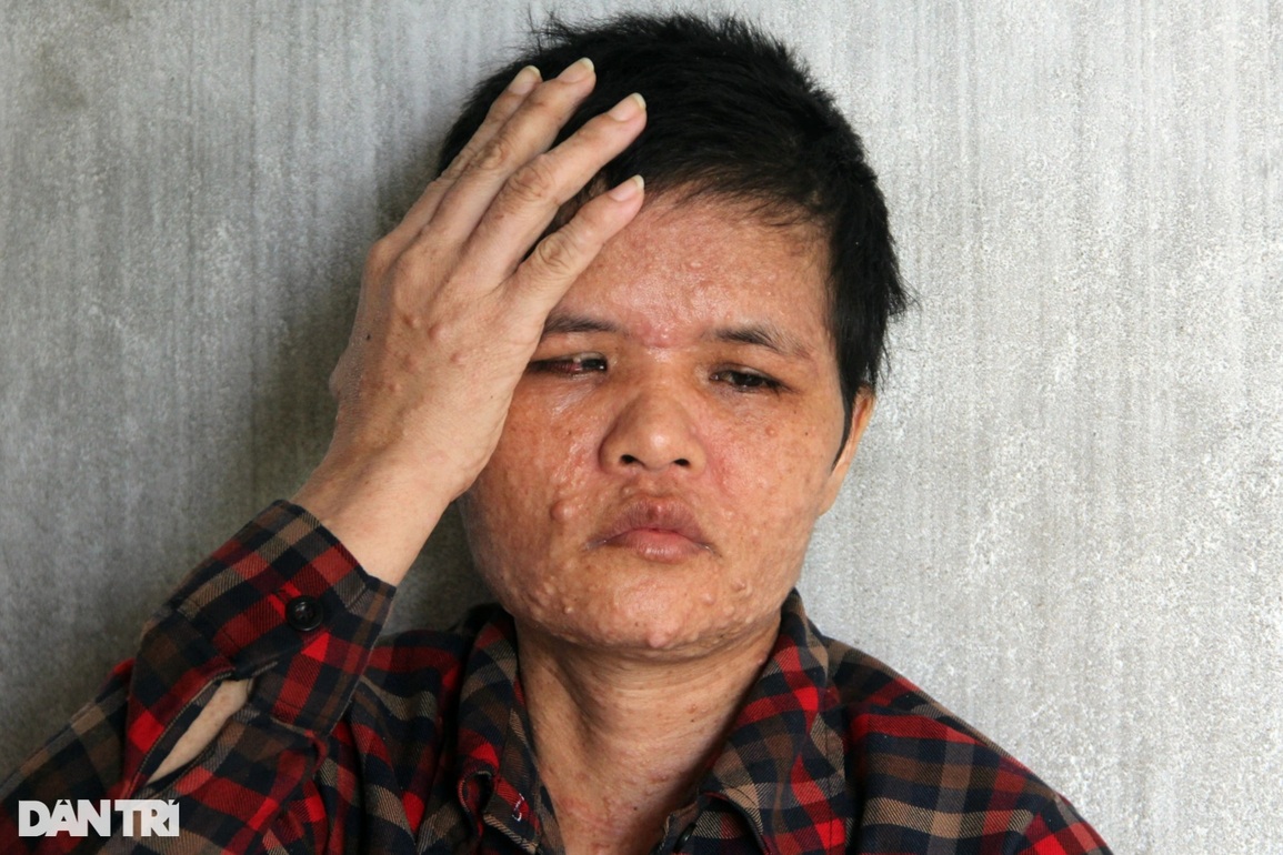 Người mẹ da cóc nuốt nước mắt chịu bệnh tật dày vò dành tiền học cho con - 3 Người mẹ da cóc nuốt nước mắt chịu bệnh tật dày vò dành tiền học cho con - 3
