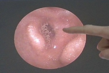 Gắp hàng trăm con dòi sống trong tai bệnh nhân