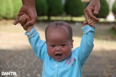 Nụ cười rạng rỡ của bé gái người Nùng thoát kiếp "người cá"