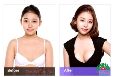 Nâng ngực nội soi đẹp Hàn Quốc