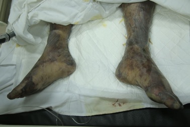 Những hình ảnh gây sốc về bệnh liên cầu lợn