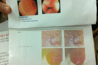 Thêm nguy kịch vì tin quảng cáo “nổ” chữa trĩ tại phòng khám tư