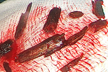 Hốc mắt trào mủ vì 10 mảnh dị vật “bỏ quên”