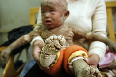 Cậu bé "vảy cá" ở Trung Quốc