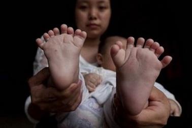 Bé trai có 15 ngón tay và 16 ngón chân