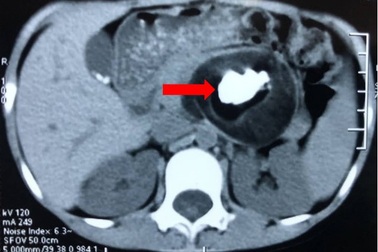 Bé gái 7 tuổi vô tình được phát hiện u quái trong bụng nhờ bị viêm phổi