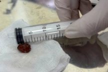 TPHCM: Người đàn ông cấp cứu ở 2 bệnh viện sau tai nạn vì cười giỡn khi ăn