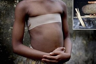 Ghê sợ tục dùng đá nóng ép phẳng ngực các bé gái để tránh bị quấy rối