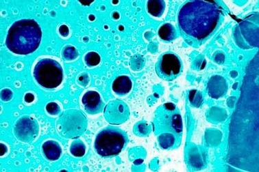 “Huấn luyện” tế bào tiêu diệt bệnh bạch cầu