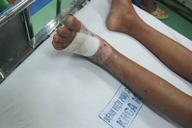 Bị rắn cực độc cắn, bé 14 tuổi suýt hoại chi