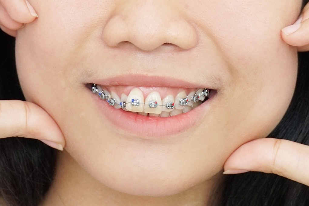 Hô hàm nhẹ có niềng răng được không? - 2